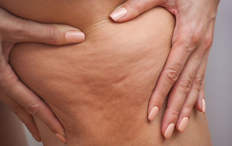 Woman showing cellulite