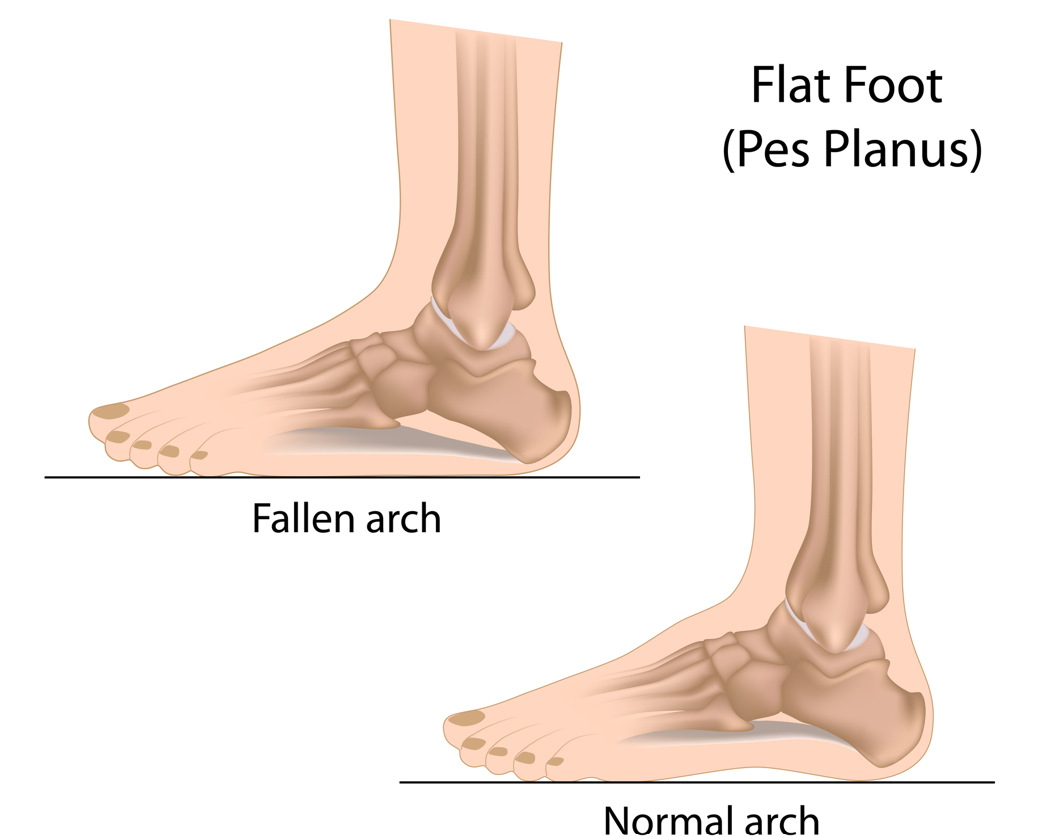 flat foot vs normal arch flat foot vs normal arch