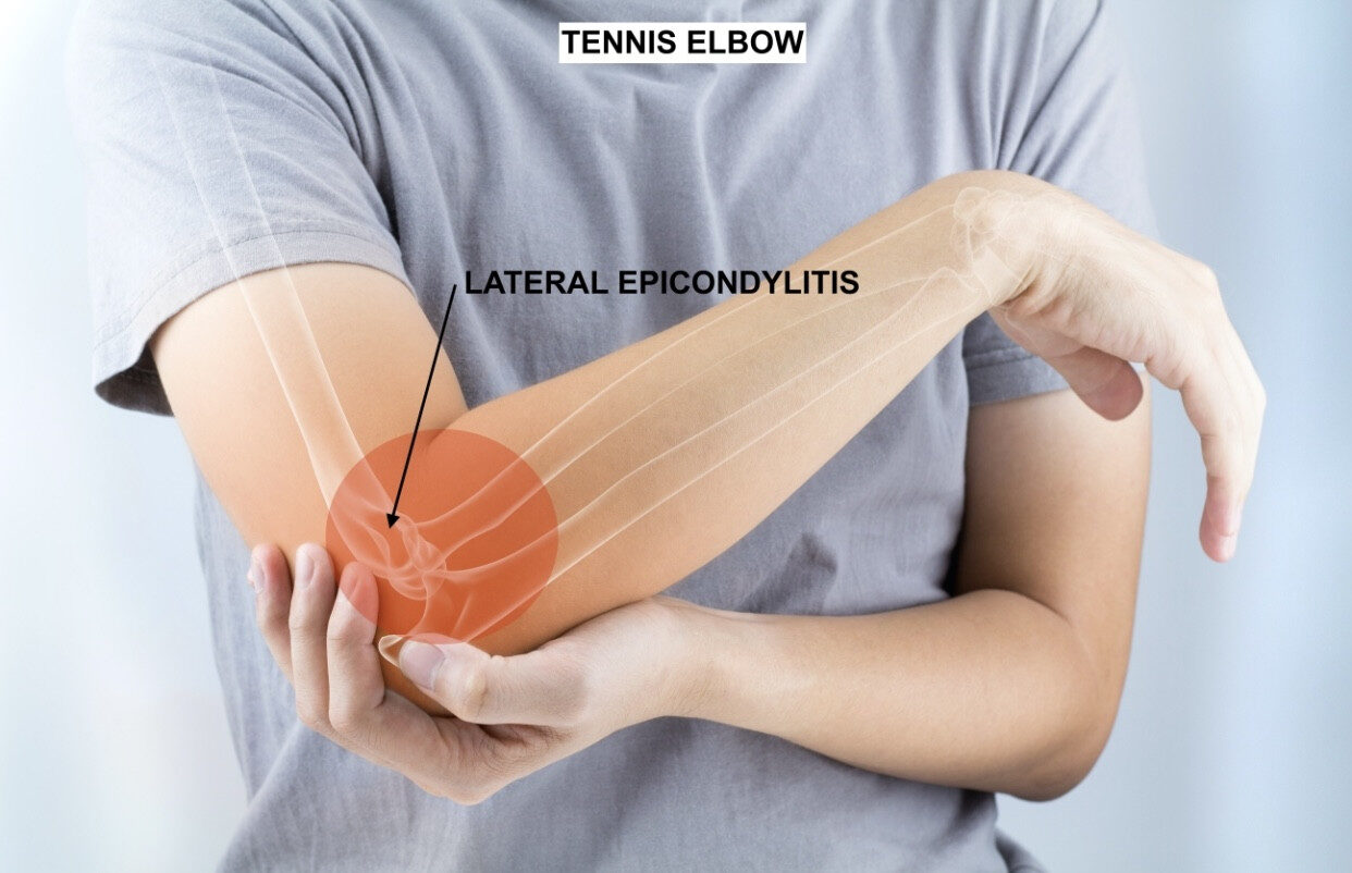Tennis Elbow Tennis Elbow