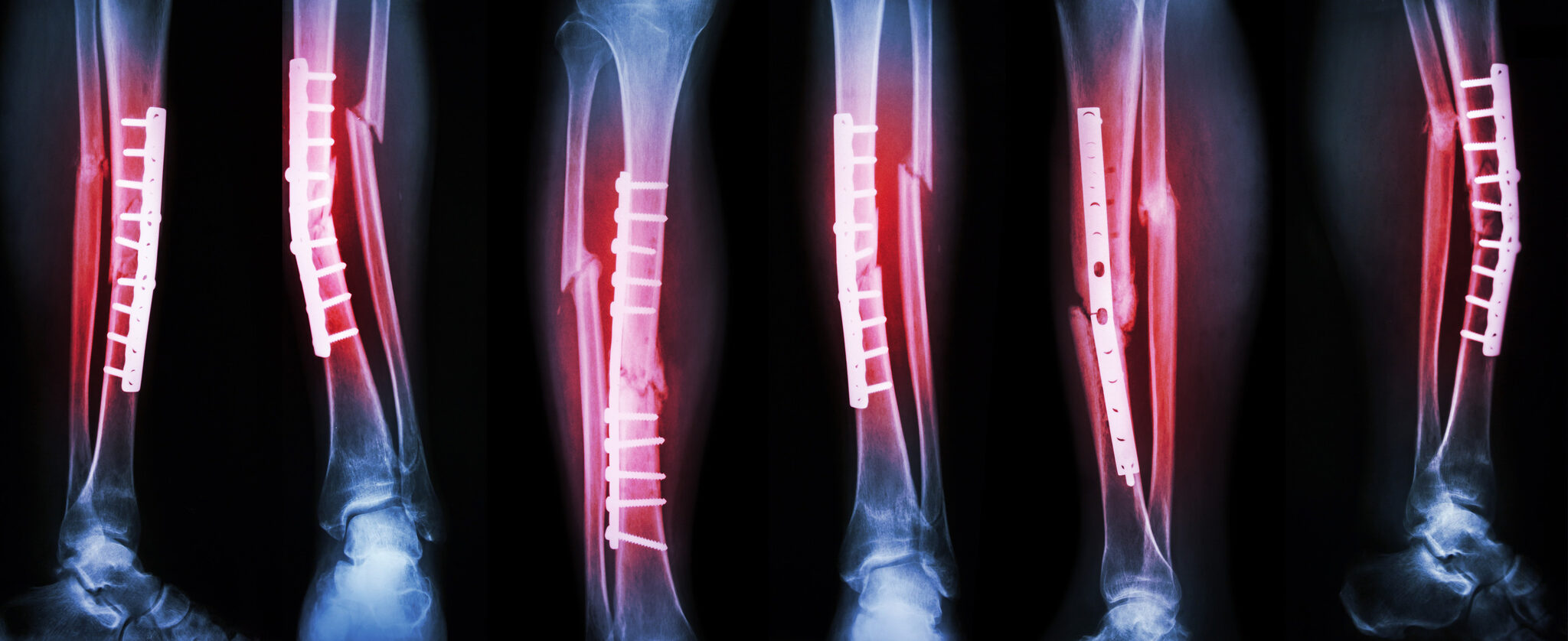 Stress Fracture